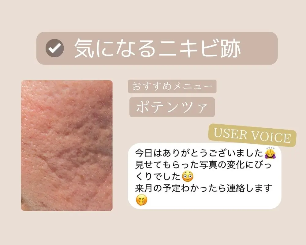 つくば-ニキビにお悩みの方