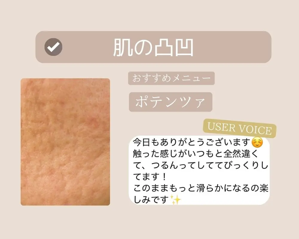 つくば市-お肌の凸凹にお悩みの方