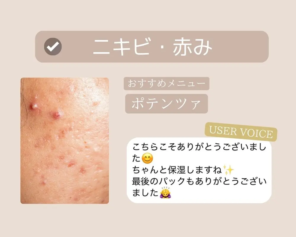 つくば市-ニキビにお悩みの方