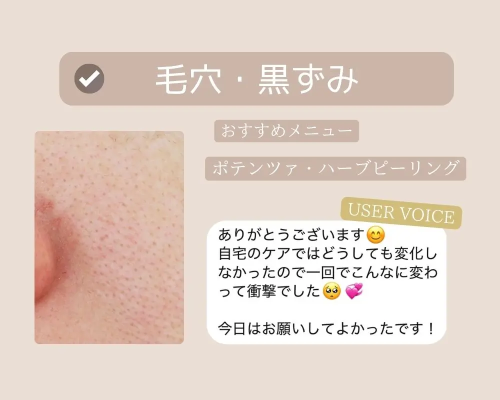 つくば市-毛穴-黒ずみにお悩みの方