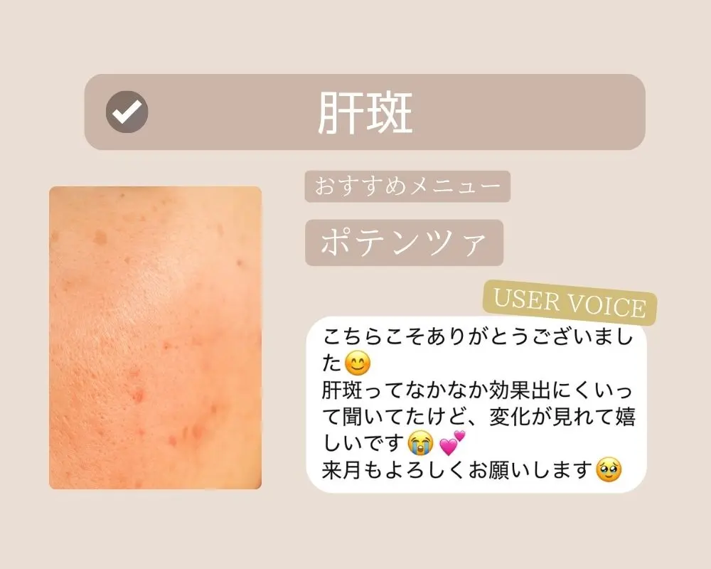 つくば市-肝斑にお悩みの方