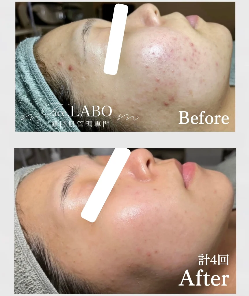 韓国肌管理-face.LABO-ポテンツァ-施術事例