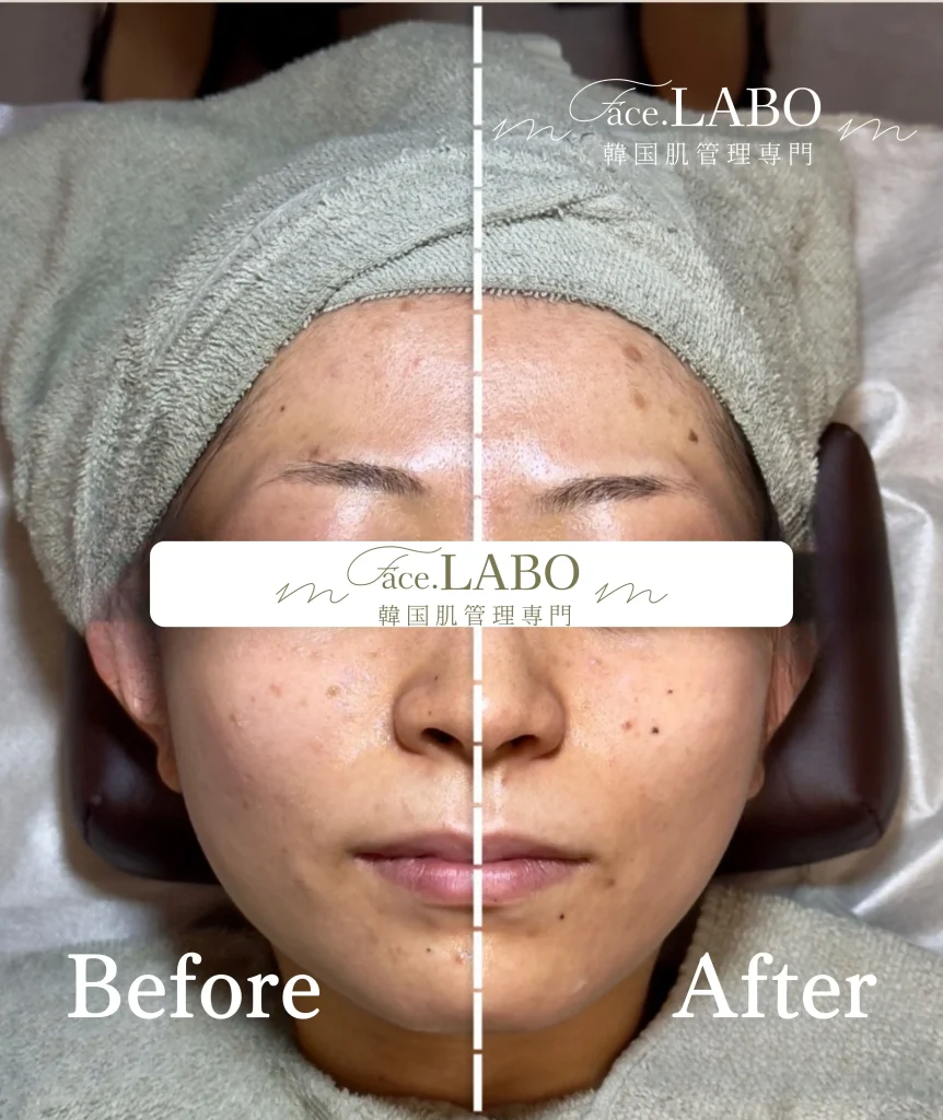 韓国肌管理専門face.LABO-オンダリフト-施術事例