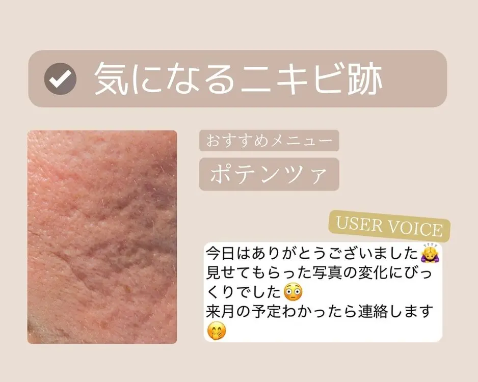 つくば-ポテンツァ-ニキビケア