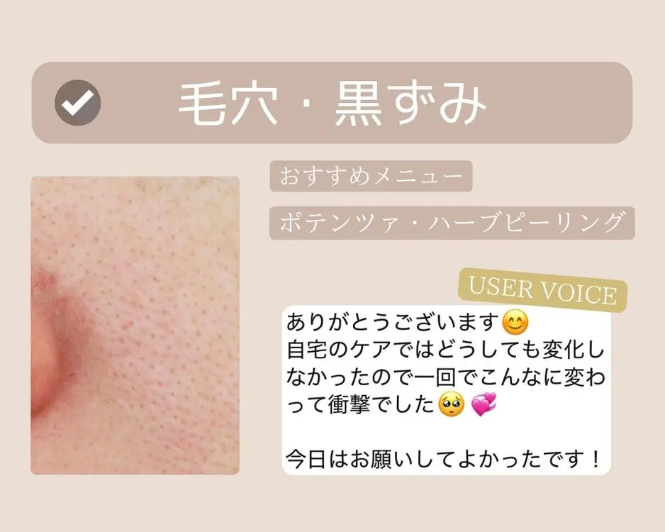 つくば-ポテンツァ-毛穴の黒ずみ