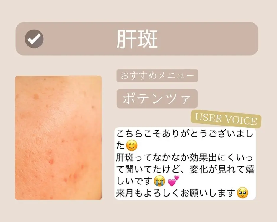 つくば-ポテンツァ-肝斑ケア