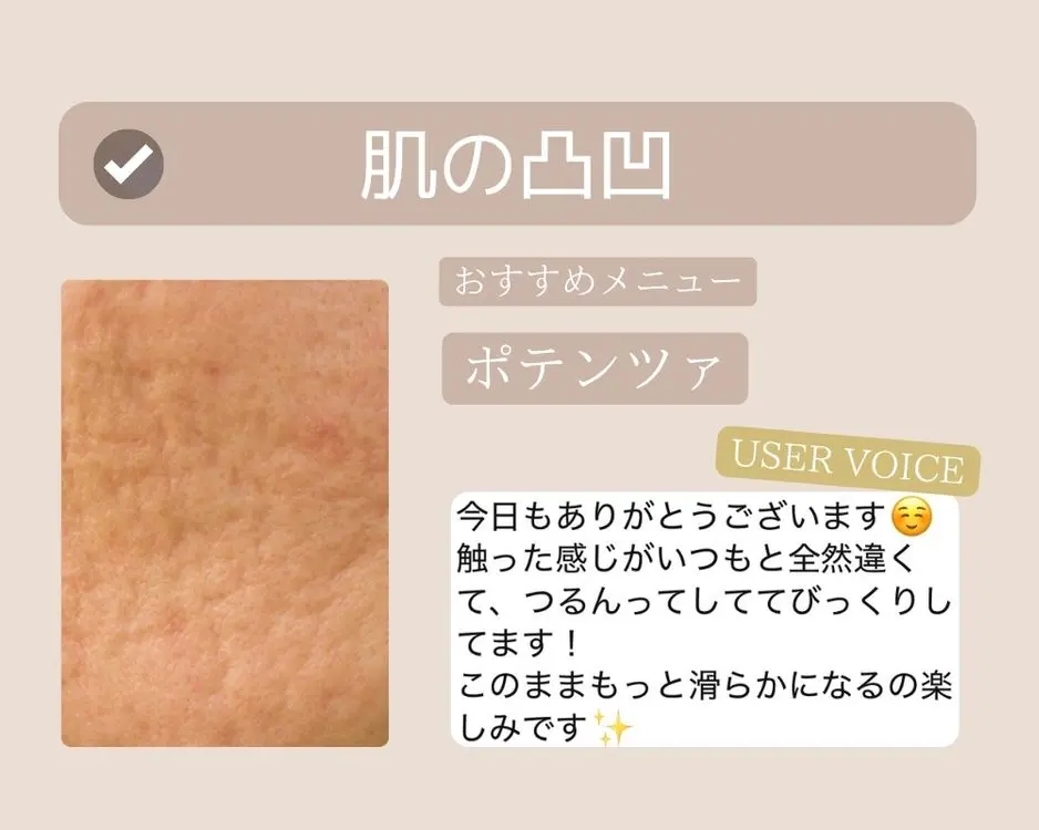 つくば市-ポテンツァ-ニキビケア
