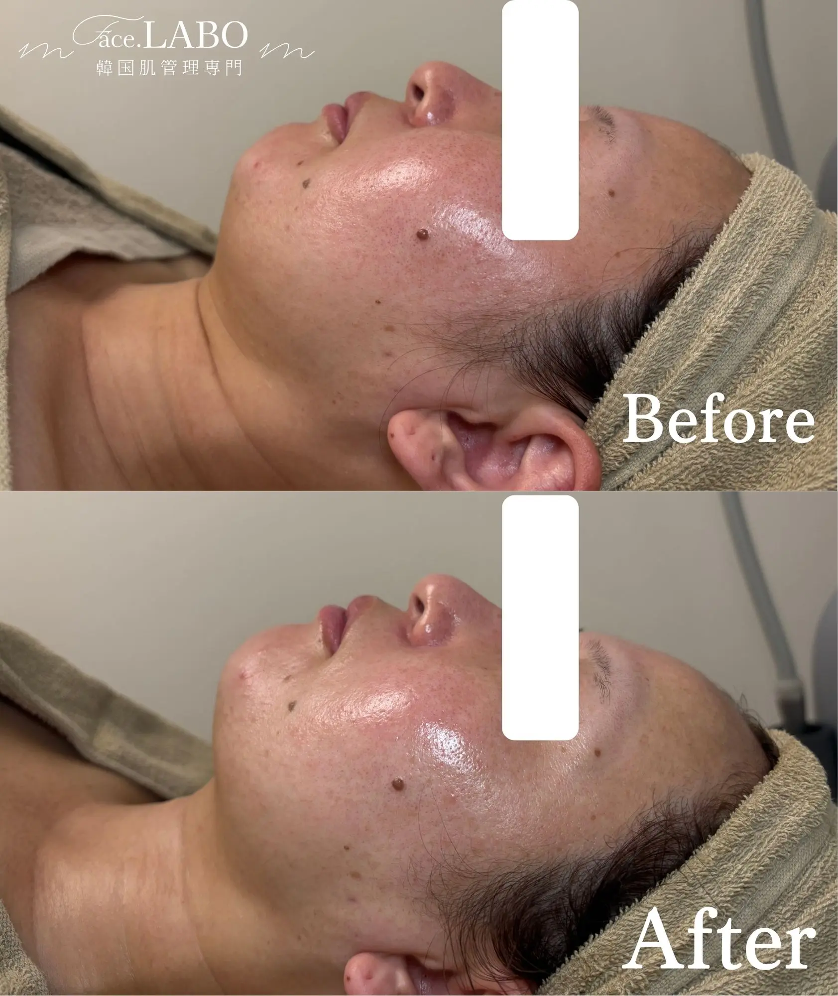 face.LABO-オンダリフト-施術後
