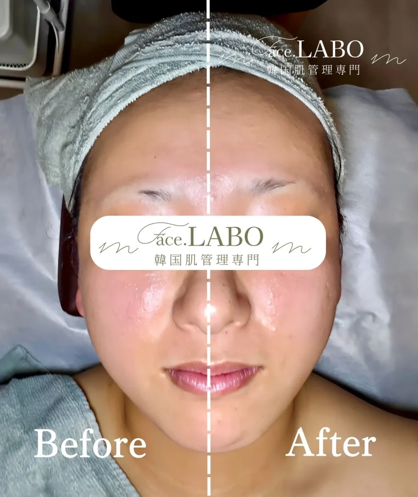 face.LABO-オンダリフト-施術後たるみ