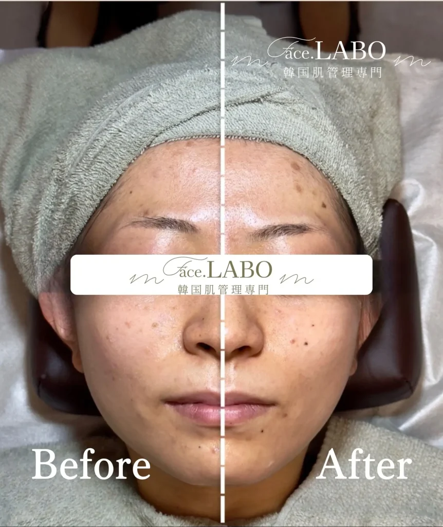 face.LABO-オンダリフト-施術後-リフトアップ