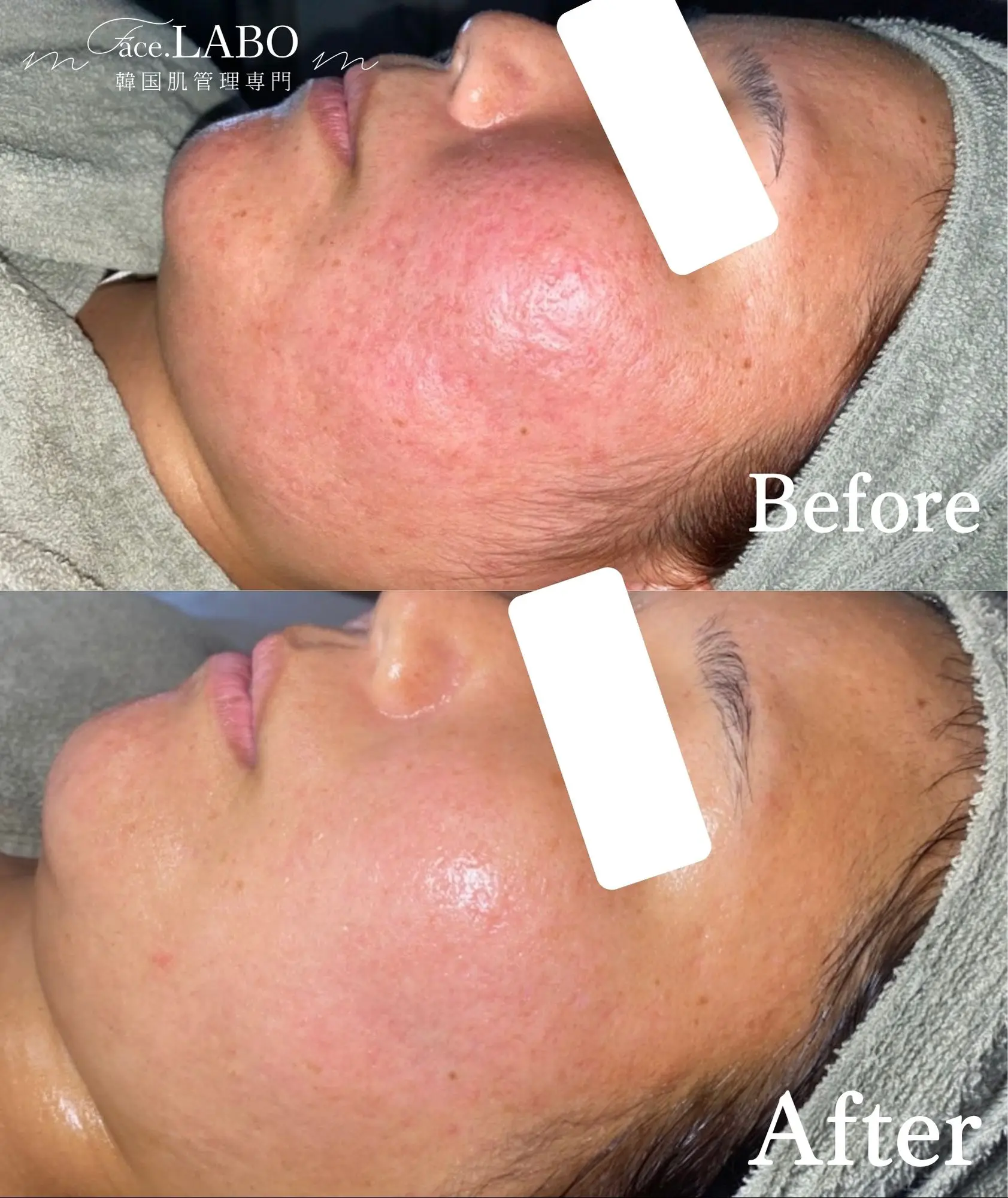 face.LABO-ポテンツァ-施術後