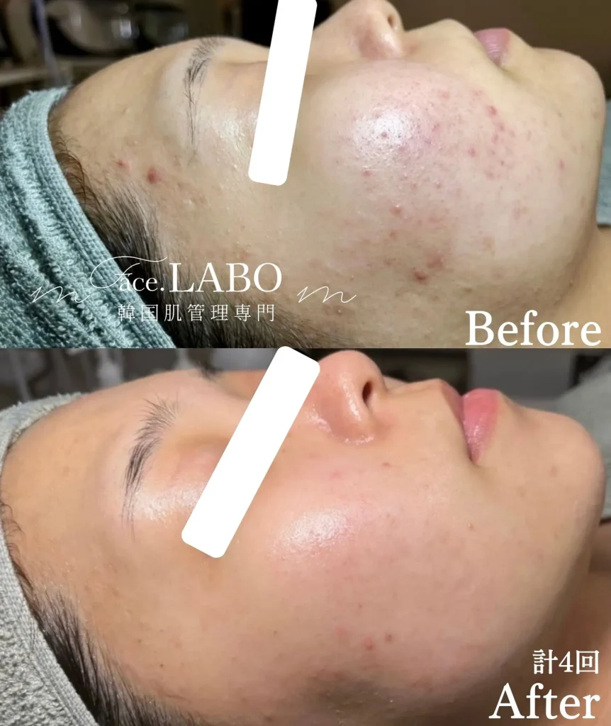 face.LABO-ポテンツァ-施術後2