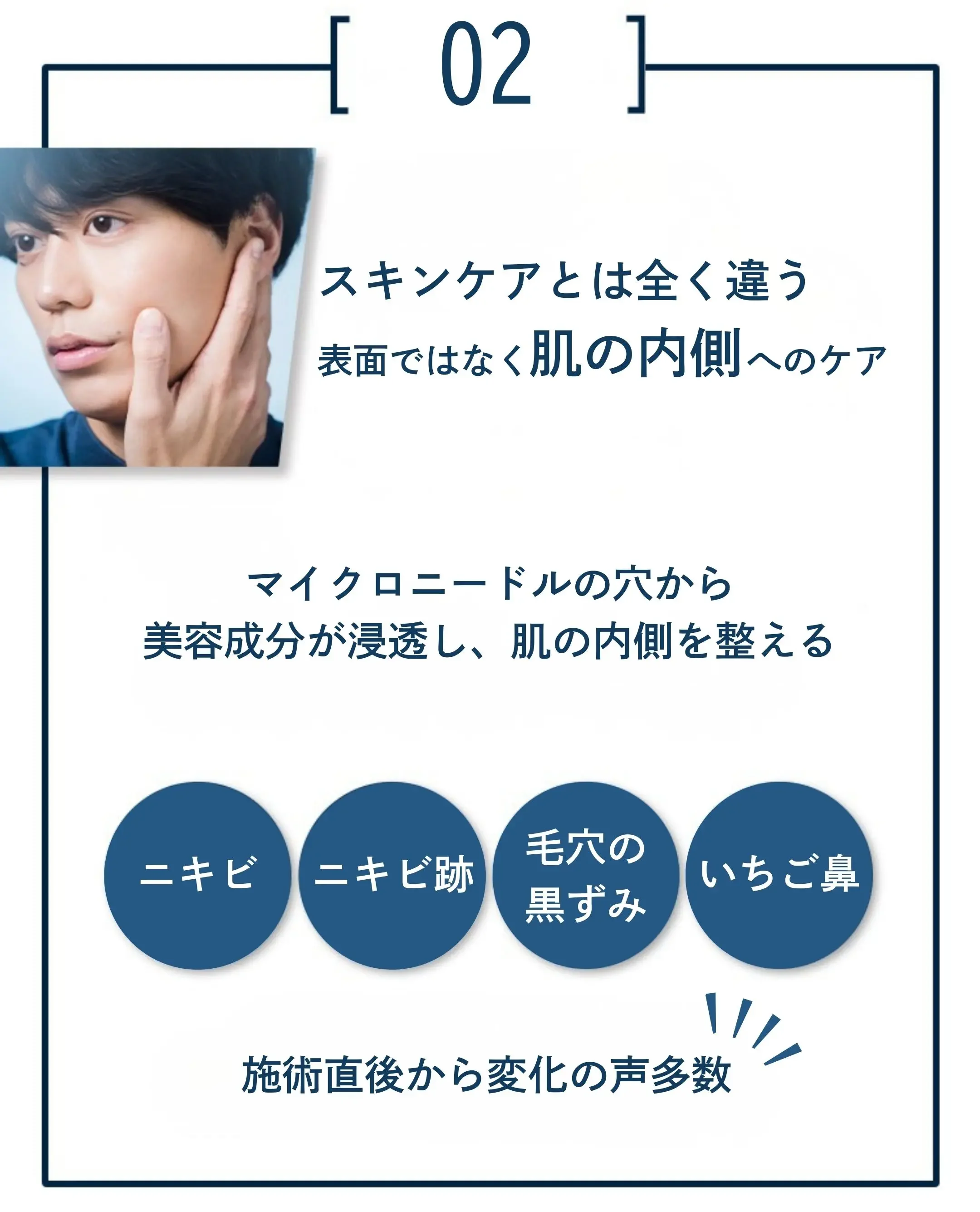 メンズニキビ-つくば市-メカニズム２
