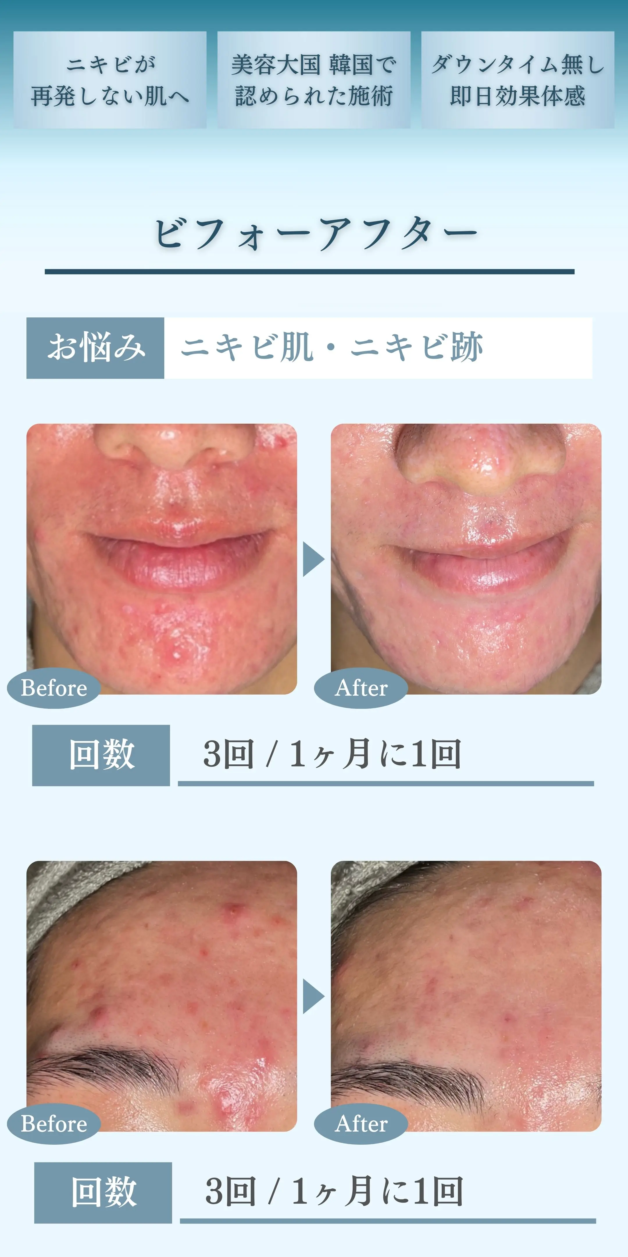 メンズニキビ-ポテンツァ-B:A