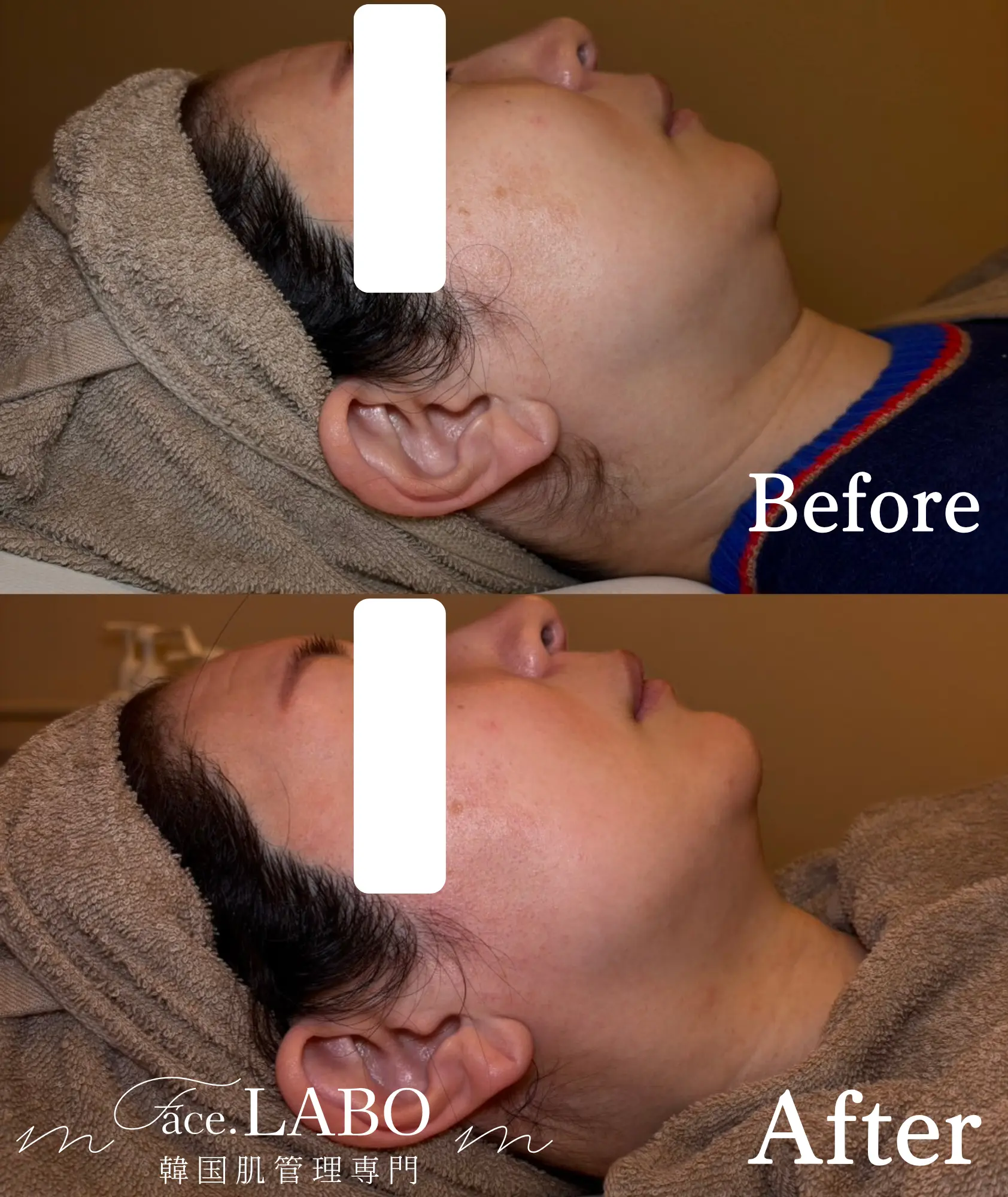 オンダリフト-たるみ-フェイスライン-もたつき